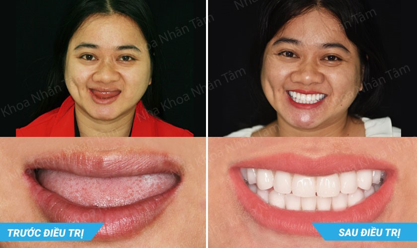 Hình ảnh khách hàng N.T.K.H trước và sau trồng răng Implant