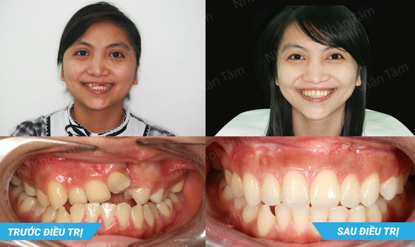 Hình ảnh trước và sau điều trị của khách hàng hở môi và hở một phần cung răng