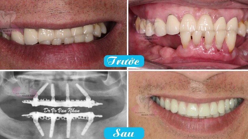 Hình ảnh trước và sau khi cấy ghép răng Implant của khách hàng