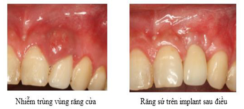 Cấy Implant sau 2 tháng nhổ răng do nhiễm trùng vùng răng cửa