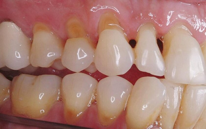Mòn cổ răng là tình trạng tổn thương mô cứng của răng