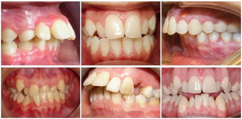 Các kiểu răng cửa bị mọc lệch phổ biến