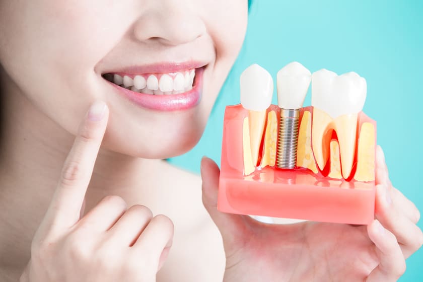 Phục hình răng cấm bị gãy rụng bằng phương pháp Implant mang đến nhiều lợi ích