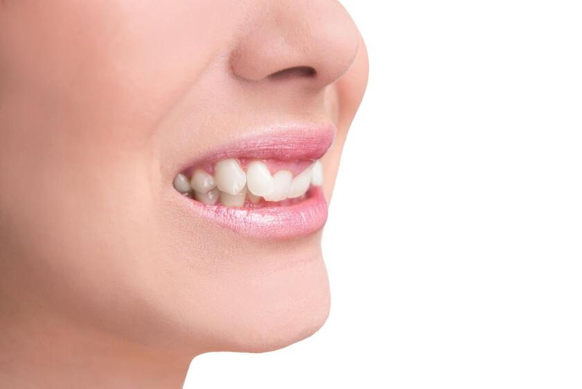 Răng khểnh thực chất là răng nanh mọc lệch