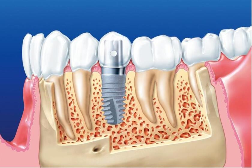 Trồng răng Implant chống tiêu xương hàm cực kỳ hiệu quả
