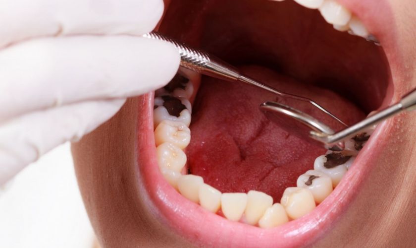 Sâu răng là một trong những nguyên nhân dẫn đến tình trạng đau răng