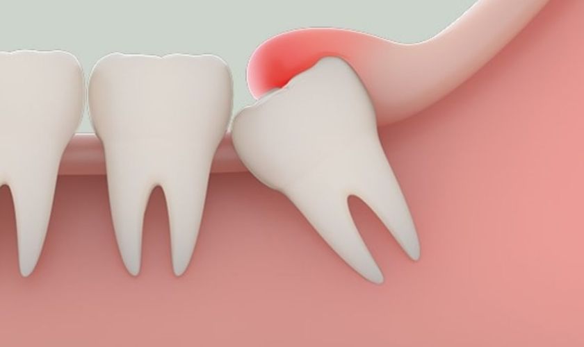 Mọc răng khôn là nguyên nhân gây ra sưng lợi răng hàm