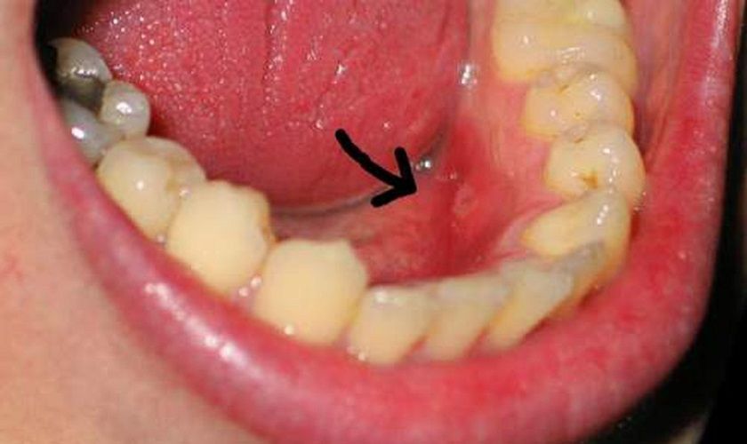 Sưng chân răng xuất phát từ bệnh lý viêm nướu, viêm nha chu và viêm tủy