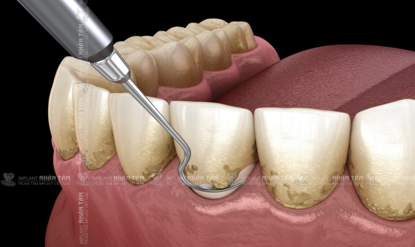 Vôi răng là nguyên nhân hàng đầu gây viêm nướu răng