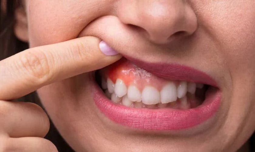 Viêm chân răng có mủ có thể dẫn đến nhiều biến chứng nghiêm trọng
