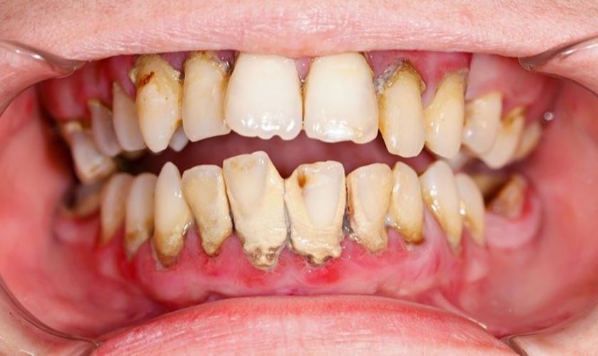 Viêm nha chu là nguyên nhân gây viêm chân răng có mủ