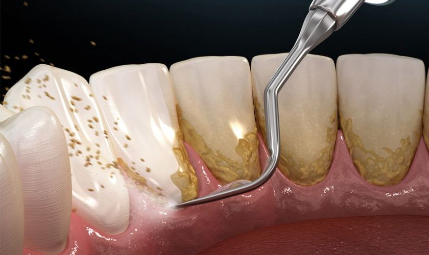 Làm sạch vôi răng tại nha khoa sẽ giúp hết sưng nướu răng