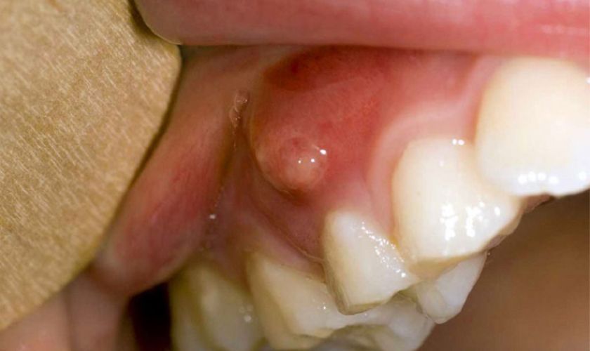 Sưng chân răng ảnh hưởng nghiêm trọng nếu không được điều trị kịp thời