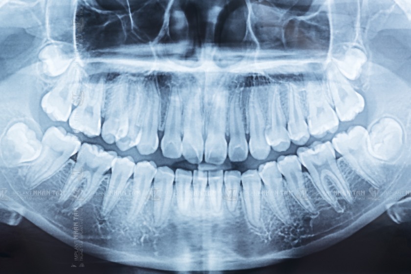 Răng khôn mọc khó thường gây viêm nhiễm nướu quanh răng khôn