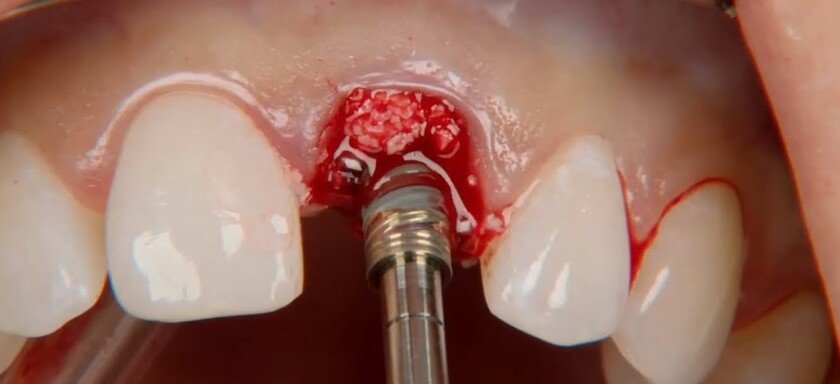 Implant Nobel TiUltra thích hợp cho nhiều trường hợp mất răng