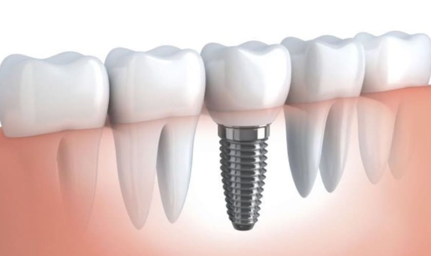 Trồng răng implant là phương pháp thay thế răng mất tiên tiến hiện