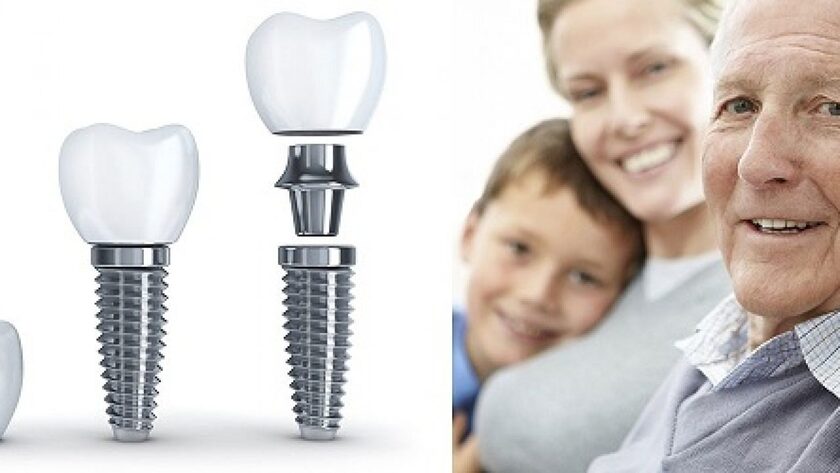 Trồng răng implant cho người lớn tuổi mang đến nhiều lợi ích