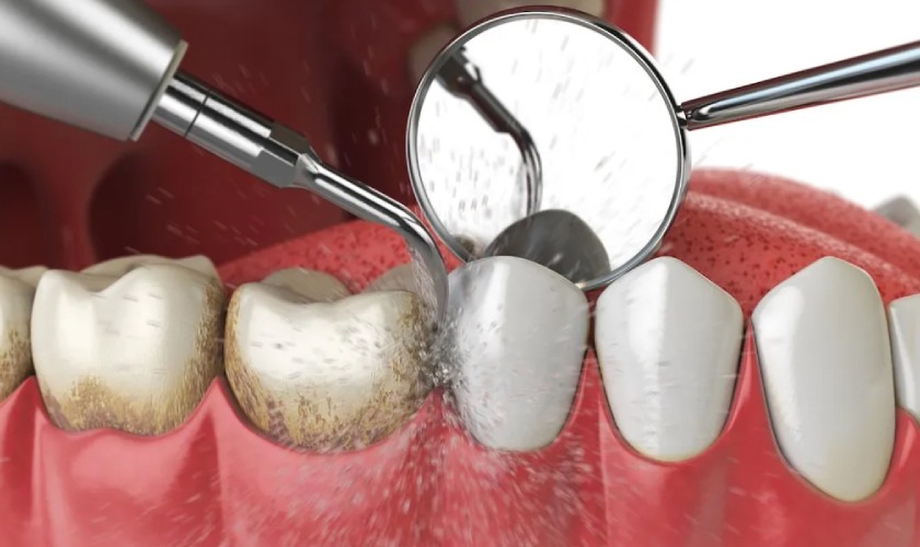 Cạo vôi răng là biện pháp vệ sinh răng miệng chuyên nghiệp