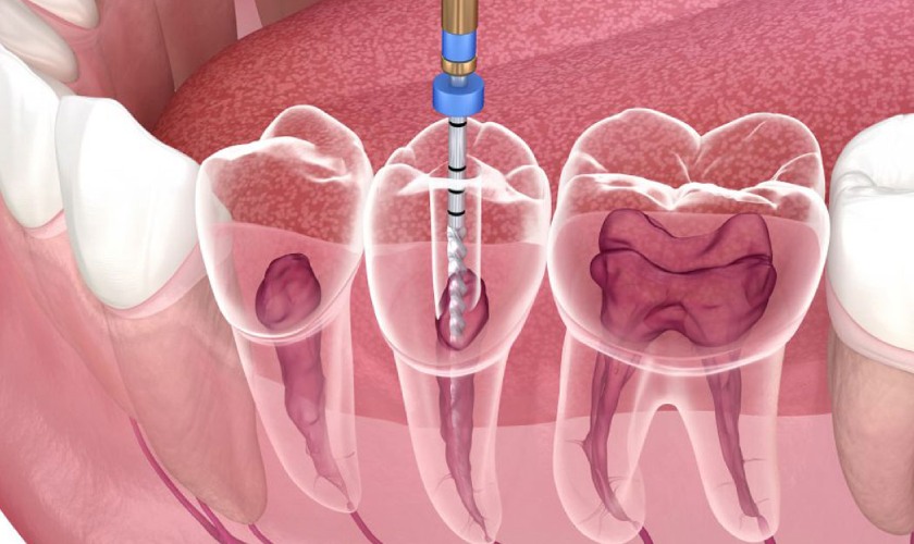 Điều trị tủy răng sẽ loại bỏ phần tùy bị tổn thương, chấm dứt cơn đau