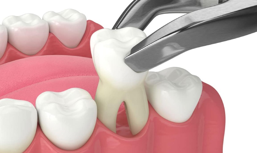 Nhổ răng là biện pháp cuối cùng khi không còn biện pháp phục hồi nào khác