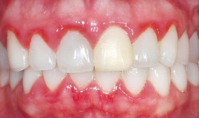 Viêm nướu khiến nướu răng bị sưng đỏ