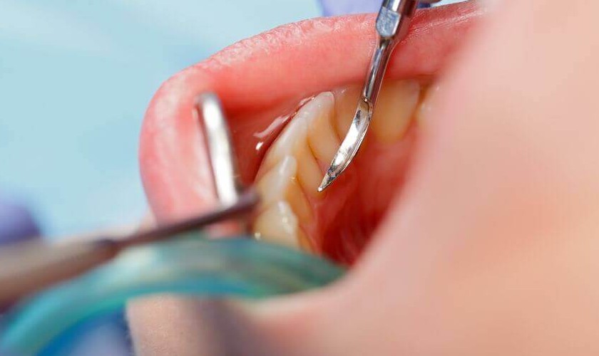 Cạo vôi răng giúp loại bỏ mảng bám, vôi răng bám lâu ngày