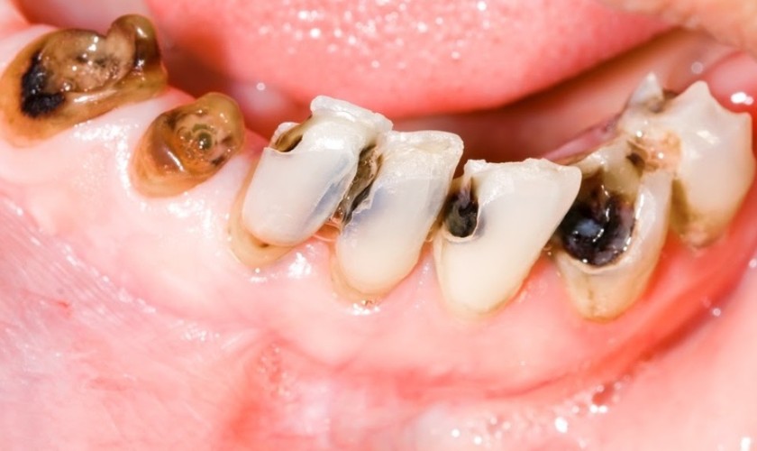 Sâu răng là nguyên nhân hàng đầu gây nhức răng