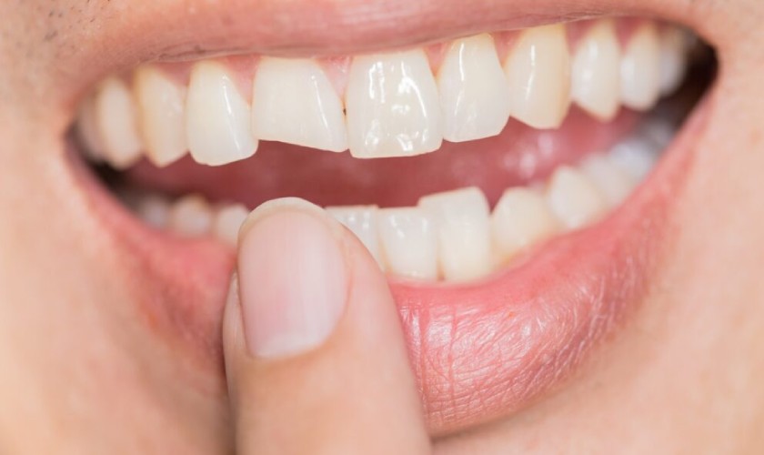 Nhức răng có thể gặp khi răng bị chấn thương